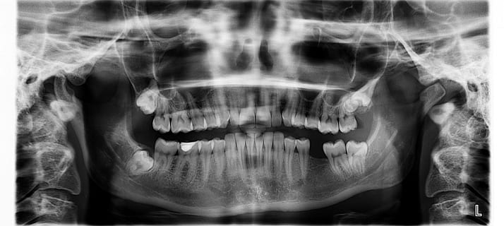 x-ray result, x ray, teeth, tooth missing, human body part, x-ray image, healthcare and medicine, bone, medical x-ray, human teeth, fear, people, spooky, horror, body part, front view, close-up, science, mouth, indoors, emotion, human mouth, mouth open, human bone, ominous, aggression, 1080P, CC0, public domain, royalty free
