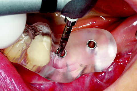 CEREC, guide, to, tæt på, indendørs, menneskelig kropsdel, mad, mad og drikke, emotion, menneskelig hånd, blod, studio skud, rød, sundhedspleje og medicin, mennesker, friskhed, vand, kropsdel, 2K, CC0, offentligt domæne, royaltyfrie