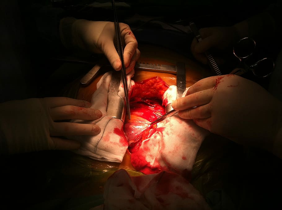operació, obert, cor, cirurgia, obert, cor, cirurgia, medicina, humà, metge, persona, funcionar, ciència, coneixement, salut, tecnologia, crack, os, clavícula, sang, part del cos humà, mà humana, salut i medicina, guant quirúrgic, ferida, mà, a l'interior, sala d'operacions, cirurgià, hospital, gent, ocupació, dues persones, part del cos, pacient, treball, persones reals, celebració, homes, equipament quirúrgic, procediment mèdic, responsabilitat, cura, 2K